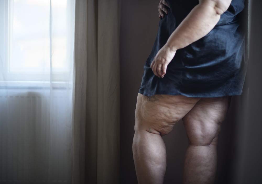 Cellulite and Hormones: Making the Connection